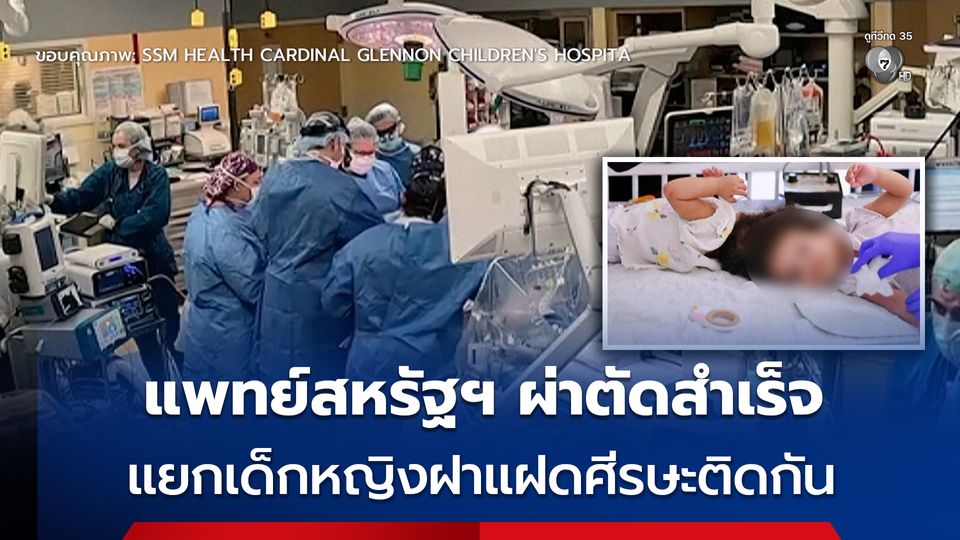 ทีมแพทย์สหรัฐฯ ทำสำเร็จ ผ่าตัดแยกเด็กหญิงฝาแฝด อายุ 2 ขวบ ที่เกิดมามีศีรษะติดกัน 